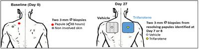 Transcriptomics Analysis Indicates Trifarotene Reverses Acne-Related Gene Expression Changes